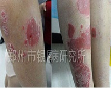 顽固银屑病成了婚姻刽子手