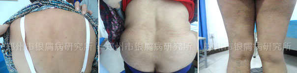 银屑病烟消云散,生活重见天日