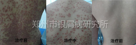 治好多年银屑病 书法爱好者题词致谢