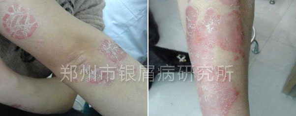 顽固银屑病成了婚姻刽子手