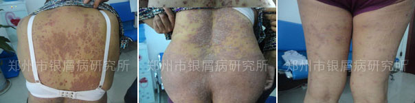 银屑病烟消云散,生活重见天日