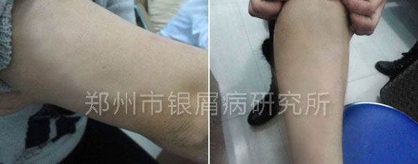 顽固银屑病成了婚姻刽子手