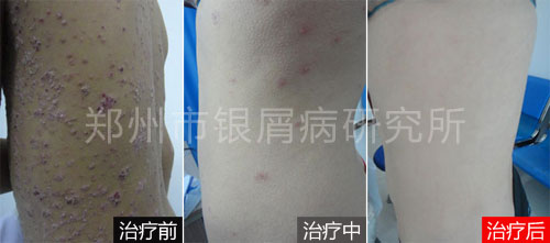 众人守护,幸运男孩战胜银屑病