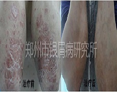 治好多年银屑病 书法爱好者题词致谢