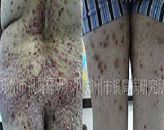 银屑病烟消云散,生活重见天日