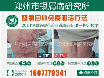 新乡哪家医院能根治银屑病